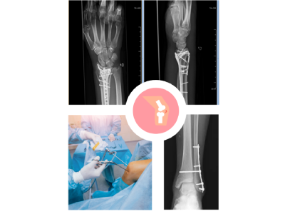 Complex Fracture Surgery