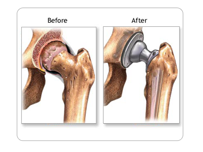 Hip Replacement
