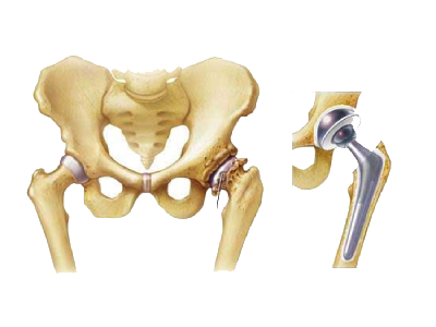 Hip Salvage Process Regrow
