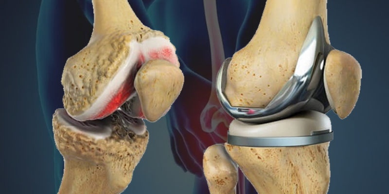 Knee Replacement