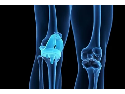 Knee Replacement