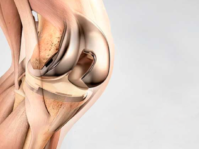Revision Knee and Hip Replacement