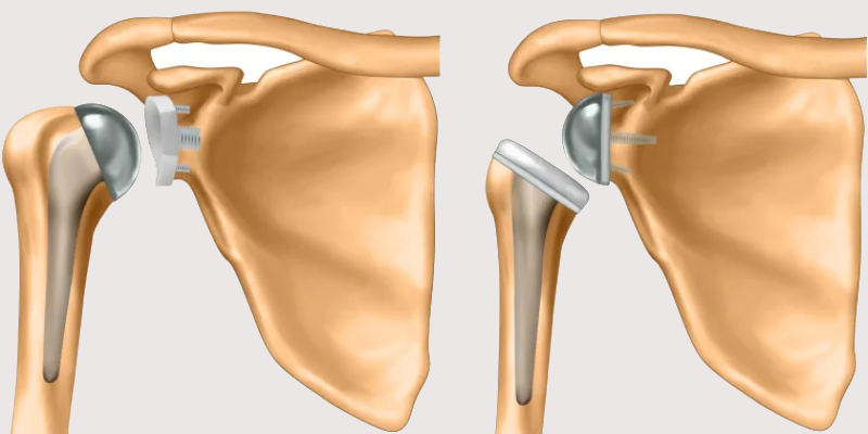 Shoulder Replacement