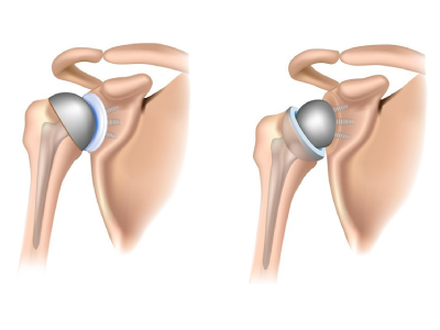 Shoulder Replacement