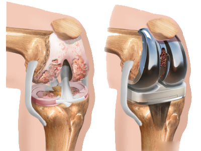 TKR Surgery